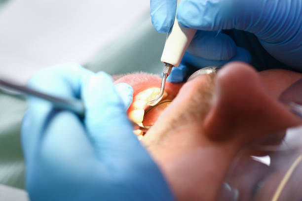 Best Emergency Dental Care for Abscessed Tooth in South Kensington, MD